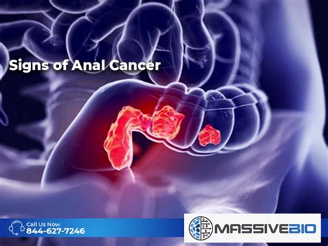 Signs Of Anal Cancer Symptoms And Causes Massive Bio