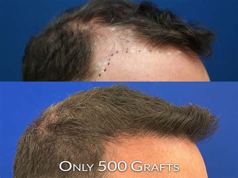 microfue hair transplants  chicago northwestern hair
