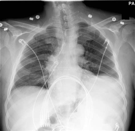 clinical notes   order  cxr  midline placement