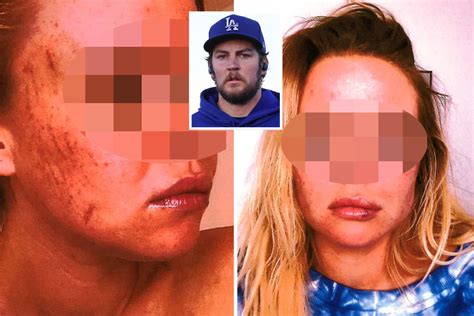 trevor bauer accuser s injuries seen in shock pics as she claims she