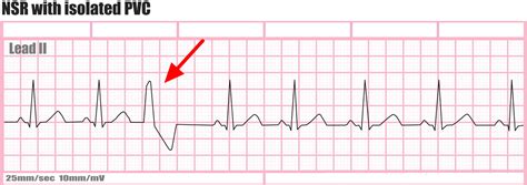 Premature Ventricular Contractions Causes Symptoms Treatment