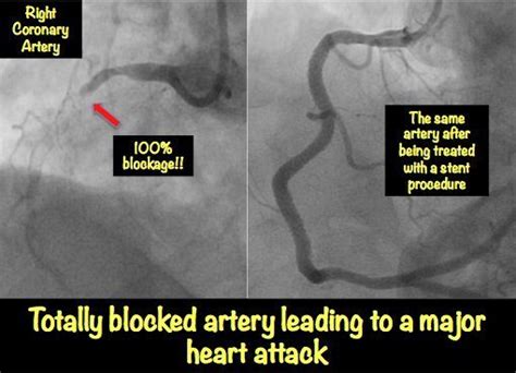 heart blockage explained  pictures