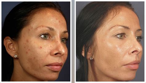 chino valley cosmetic surgery med spa vi peel   glow