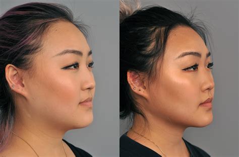 buccal fat removal  chubby cheek reduction case
