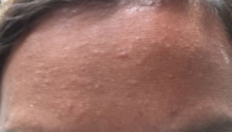small red bumps  forehead