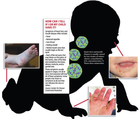 recognize hand foot  mouth disease  sumter item