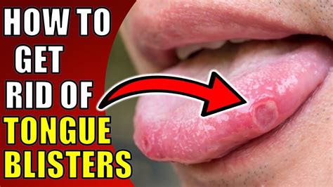 How To Get Rid Of Tongue Blisters Staybite11