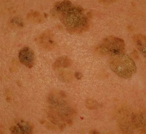 seborrheic keratosis pictures symptoms treatment removal   hubpages