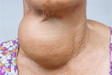 common thyroid disorders page   health
