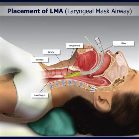 Placement Of Lma Laryngeal Mask Airway Trialexhibits Inc