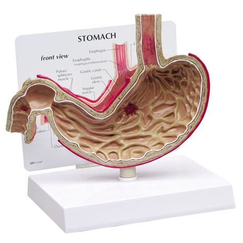 stomach anatomical model gastric ulcer