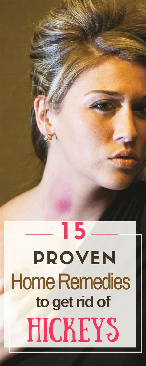 15 home remedies how to get rid of a hickey fast and overnight home