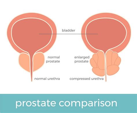 Prostate Comparison Anand Shridharani Md