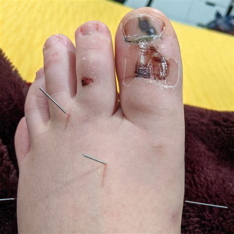 traditional chinese medicine case report broken big toe alina rehkopf