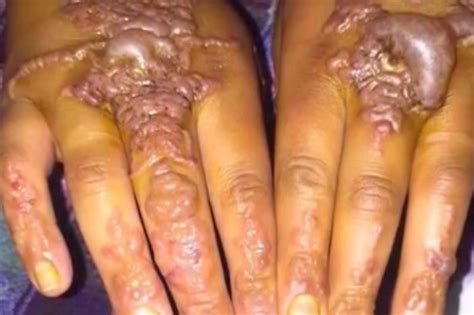 Horrific Burns Suffered By Young Woman Who Got Black Henna Tattoo On