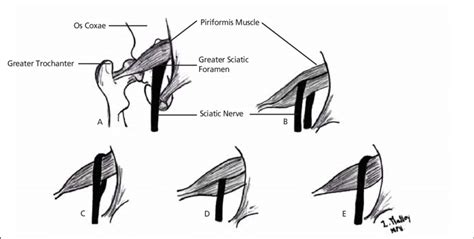 Variations In The Relationship Of The Sciatic Nerve To The Piriformis