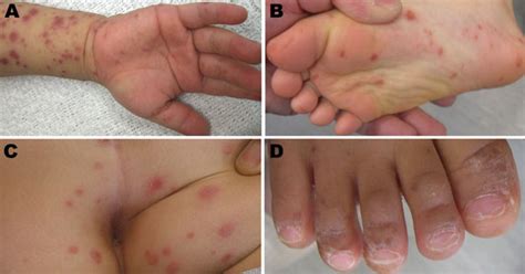 Figure Hand Foot And Mouth Disease Caused By