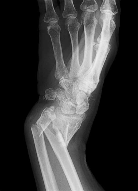 broken forearm stock images image