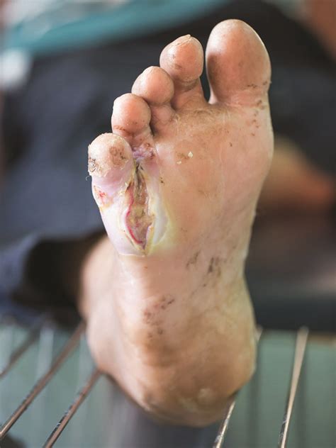 Diabetic Foot Infection Signs And Symptoms Mims Malaysia