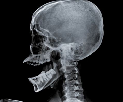 zij roentgenfoto van hoofd en hals stock afbeelding image  skelet ziekenhuis