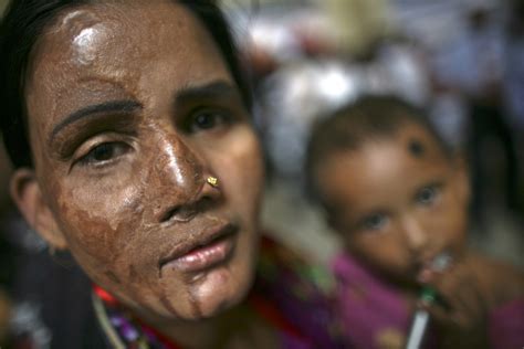 acid attack  delhi woman doctor police detain  doctor   minor ibtimes india