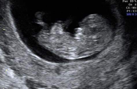 Early Pregnancy Gynaecology Ultrasound