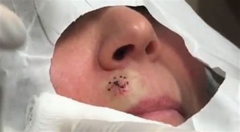 dr pimple popper busts a river rock out of a woman s upper lip
