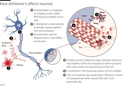 Scientists Discover New Optimism In Fight Against Alzheimers