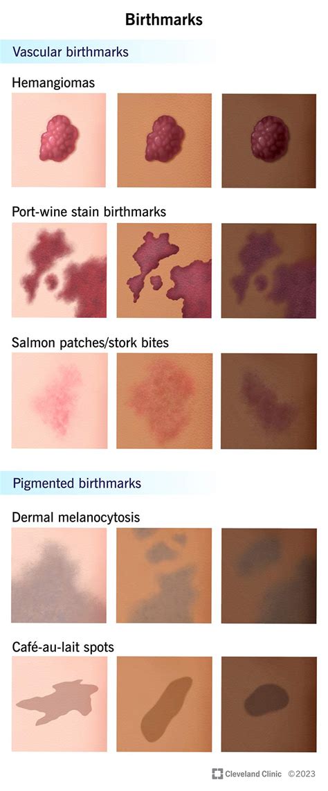 birthmark  treatments