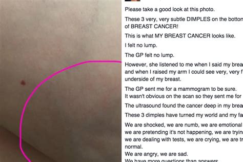 this woman posted a photo of her breast cancer as a warning for everyone