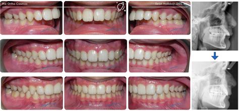 treat challenging malocclusions  invisalign  ortho cosmos