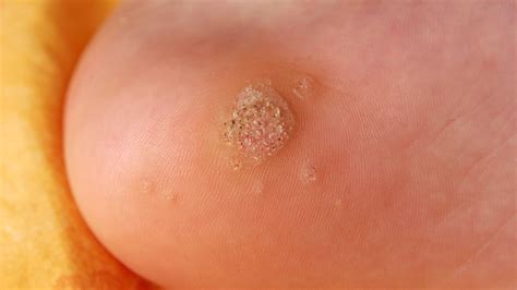 what color are warts on feet