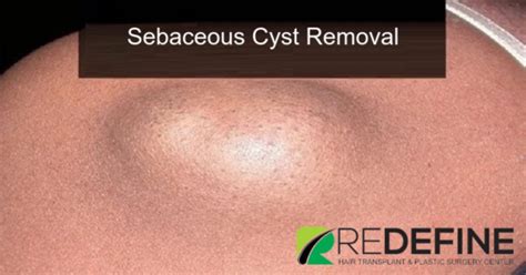 sebaceous cyst removal in hyderabad sebaceous cyst removal surgery cost