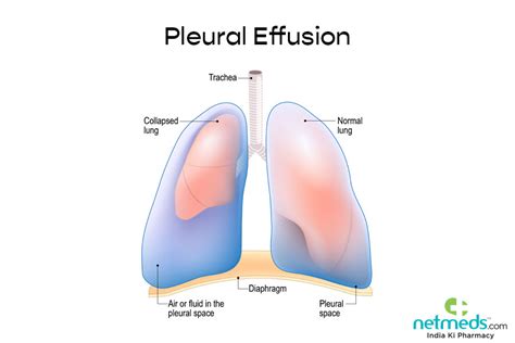 pleural effusion  symptoms  treatment netmeds