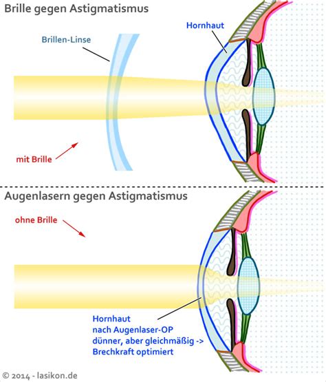 astigmatismus hornhautverkruemmung wiki lasikon