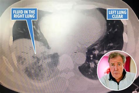 jeremy clarkson shares x ray showing just how bad his pneumonia is