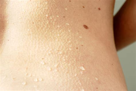 Skin Cancer Bumps On Neck