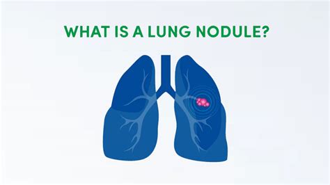 lung nodules important facts  figures infographic