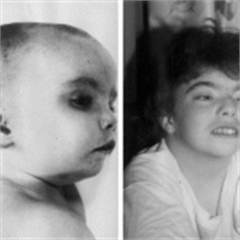 digeorge syndrome  symptoms treatment pictures healthmd