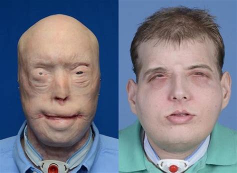 Face Transplant Before And After Photos From Most Extensive Procedure