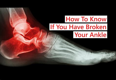broken  ankle sports injury physio