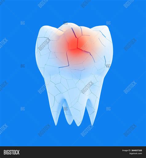 broken molar tooth red image photo  trial bigstock