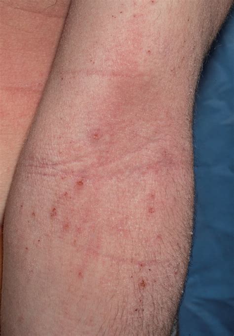 role   microbiota  eczema findings suggest  striking
