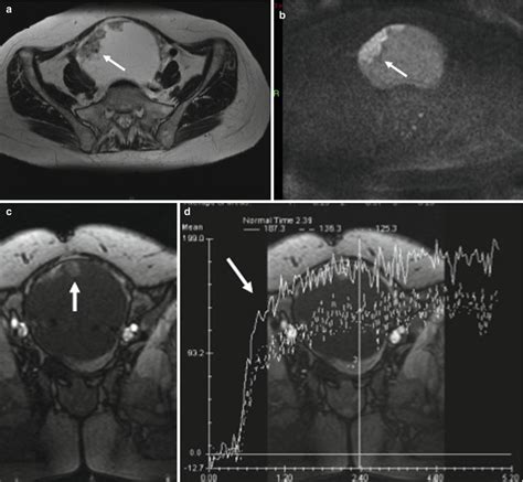 imaging  ovarian adenocarcinoma serousmucinousendometrioid radiology key