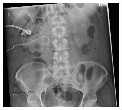 plain abdominal x ray following insertion of a percutaneous drain into download scientific