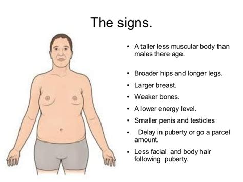 Klinefelter Syndrome – What Are The Signs And The Symptoms Of The