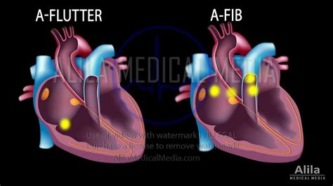 alila medical media types of angina narrated animation medical