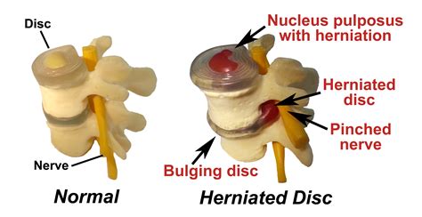 herniated disc  joint rehab center crown point indiana
