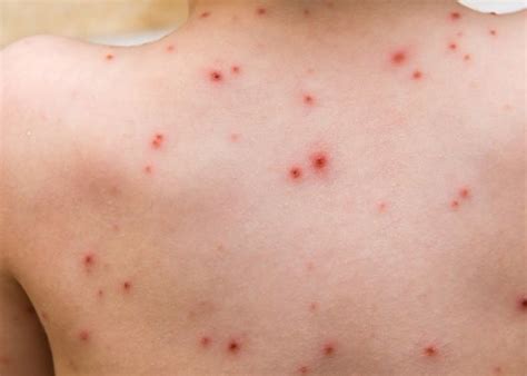 Recognise The Symptoms Of Scarlet Fever And Chickenpox News