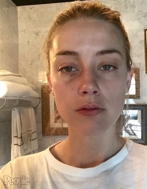 Amber Heard Pictured After ‘johnny Depp Assault’ Shows